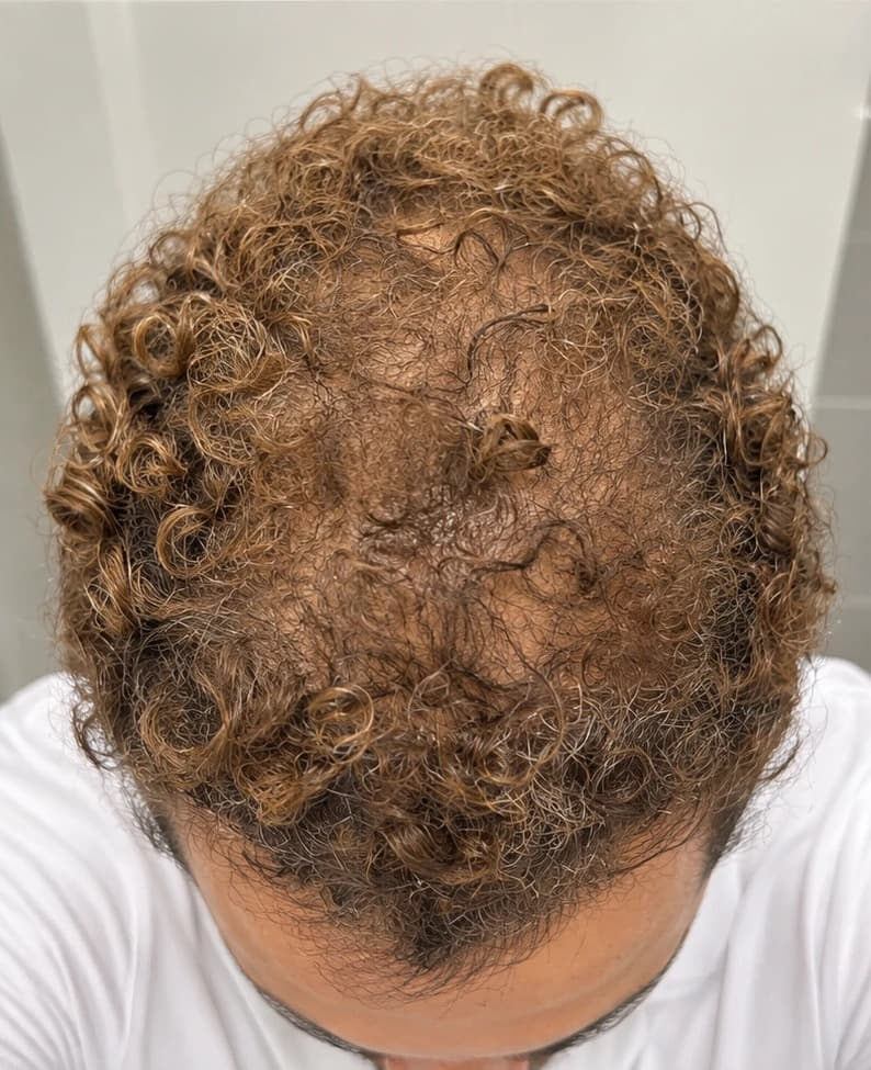 Top of a patient's head, after treatment