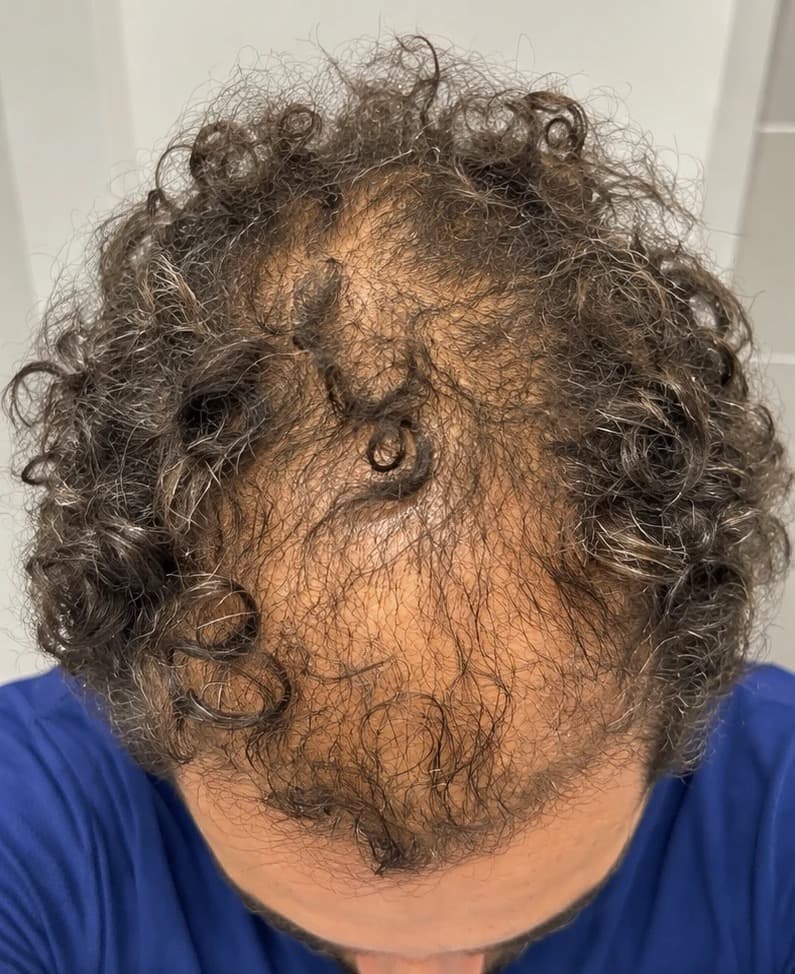 Top of a patient's head, before treatment